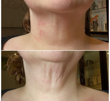 NOT ALL NECK LINES COME FROM AGEING!